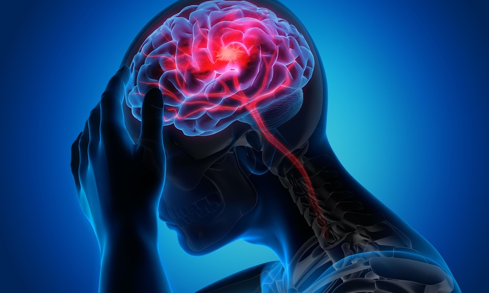 migraine symptoms usa