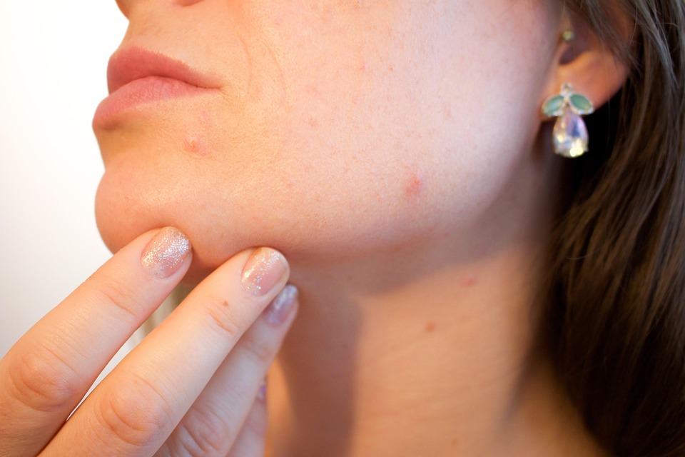 acne treatment usa